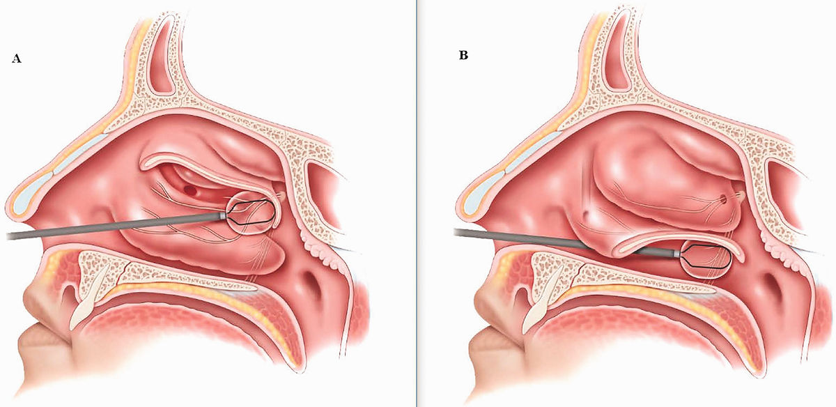 A diagram of the ClariFix Procedure which involves insertion of ClariFix wand in nasal cavity.