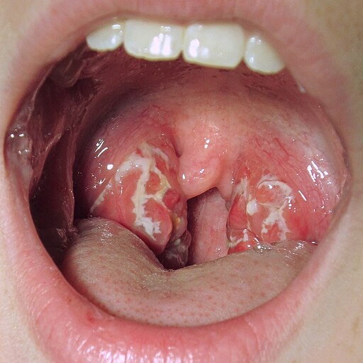 A case of strep throat, culture positive   |   James Heilman, MD, CC BY-SA 3.0, via Wikimedia Commons