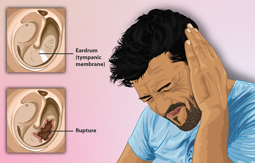 Depiction of a man with a ruptured eardrum.