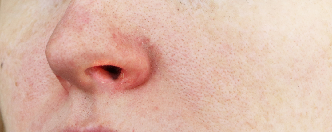 Nasal vestibulitis