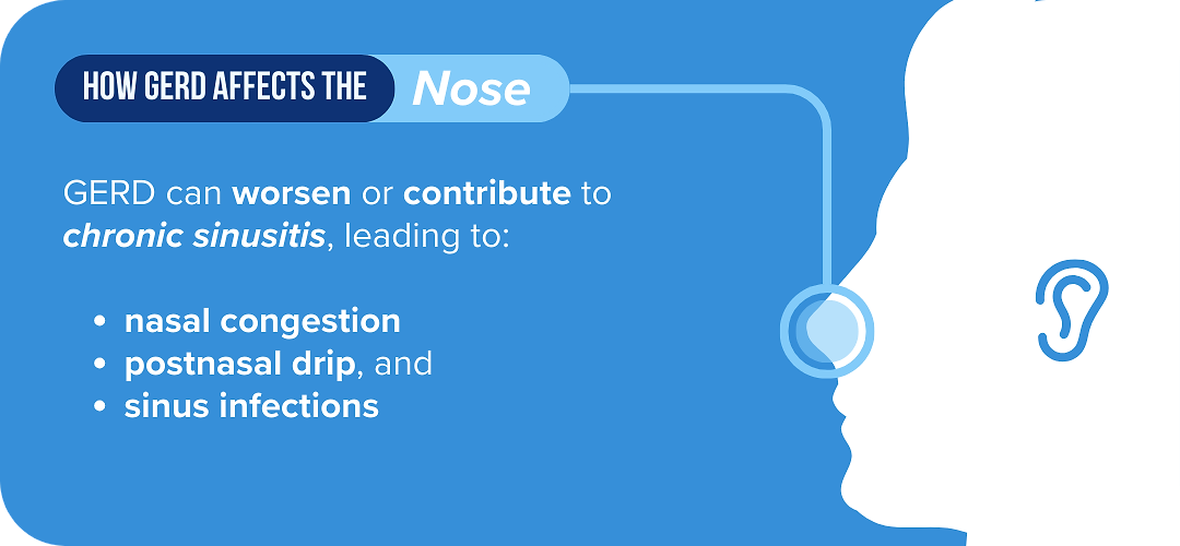 Infographic about symptoms that may arise when GERD leads to chronic sinusitis.