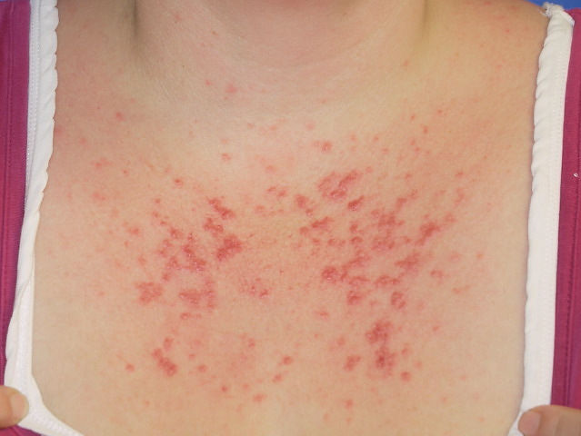 A type of sun allergy, polymorphic light eruption.