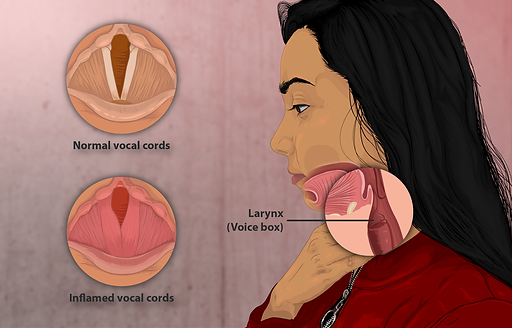  Depiction of a person suffering from Dysphonia (hoarseness)