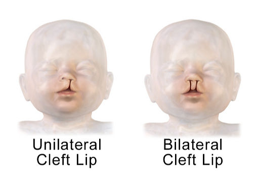 An illustration showing both a unilateral & bilateral cleft lip