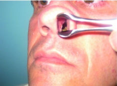 Pre-operative anterior rhinoscopy 