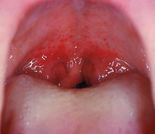 Streptococcal pharyngitis  |  CDC/Dr. Heinz F. Eichenwald, Public domain, via Wikimedia Commons
