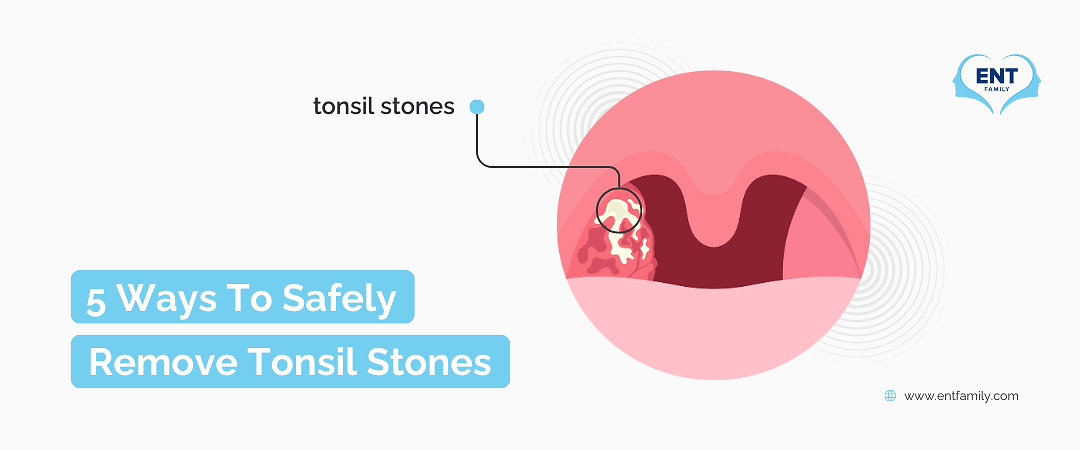 Title thumbnail with an illustration of tonsil stones. 