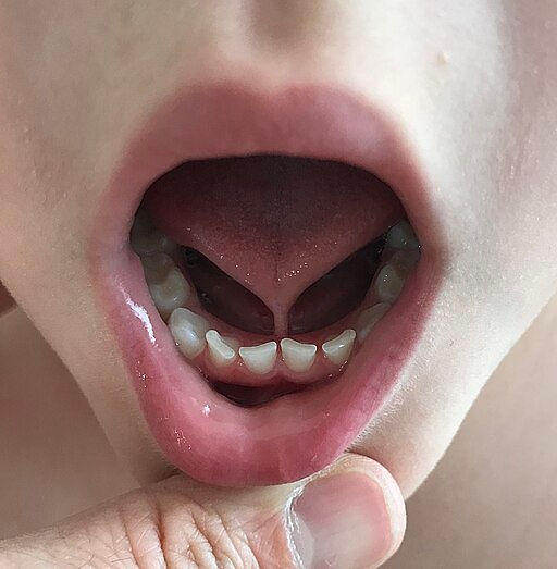 Ankyloglossia (tongue-tie) due to a short lingual frenulum, in a 4 years old child.