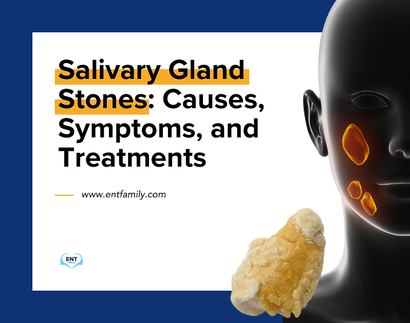 Salivary Gland Stones: Causes, Symptoms, and Treatments