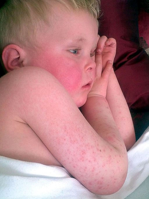 Scarlet Fever   |   www.badobadop.co.uk, CC BY-SA 3.0, via Wikimedia Commons