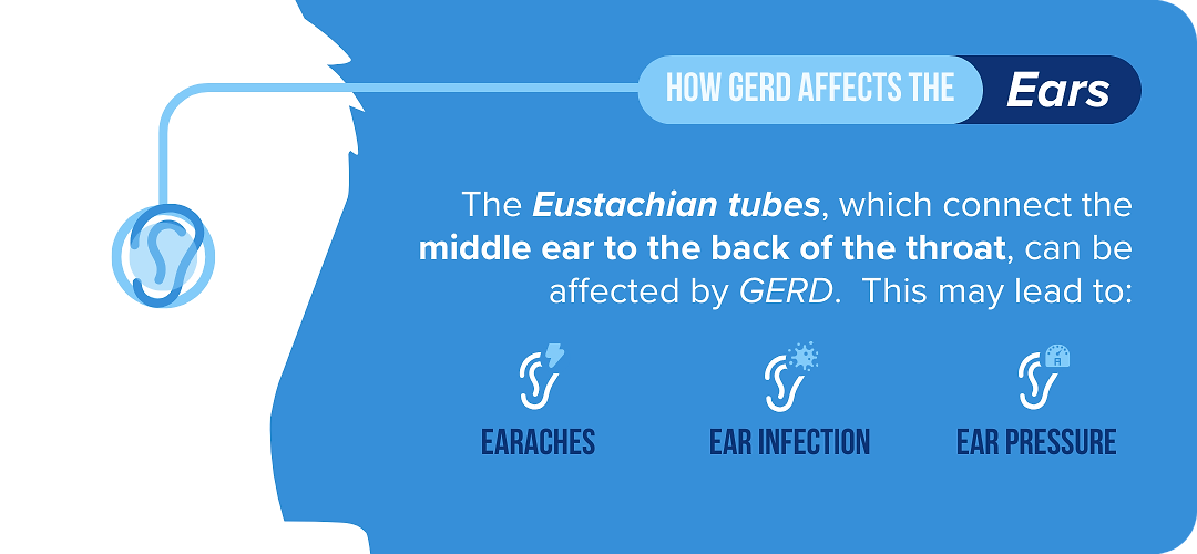 Infographic on how GERD may affect the ears through earaches, ear infections, and ear pressure. 