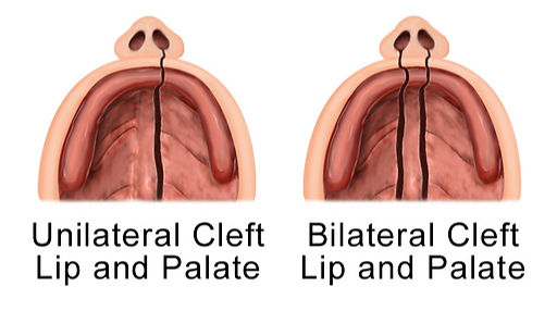 An illustration showing both a unilateral & bilateral cleft lip and palate
