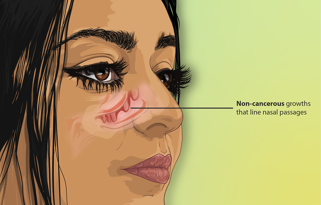Depiction of Nasal Polyps