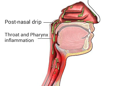 post-nasal drip