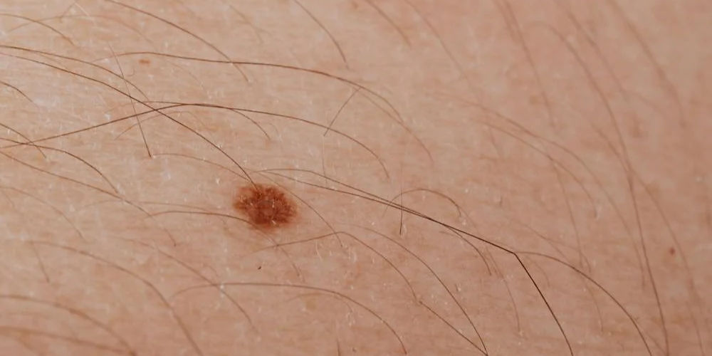 a mole