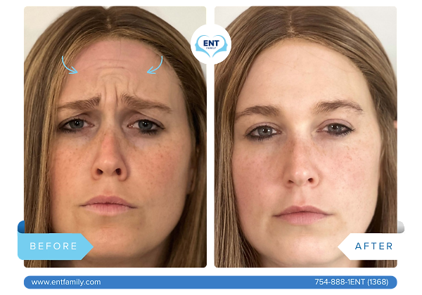 Dysport for Glabella